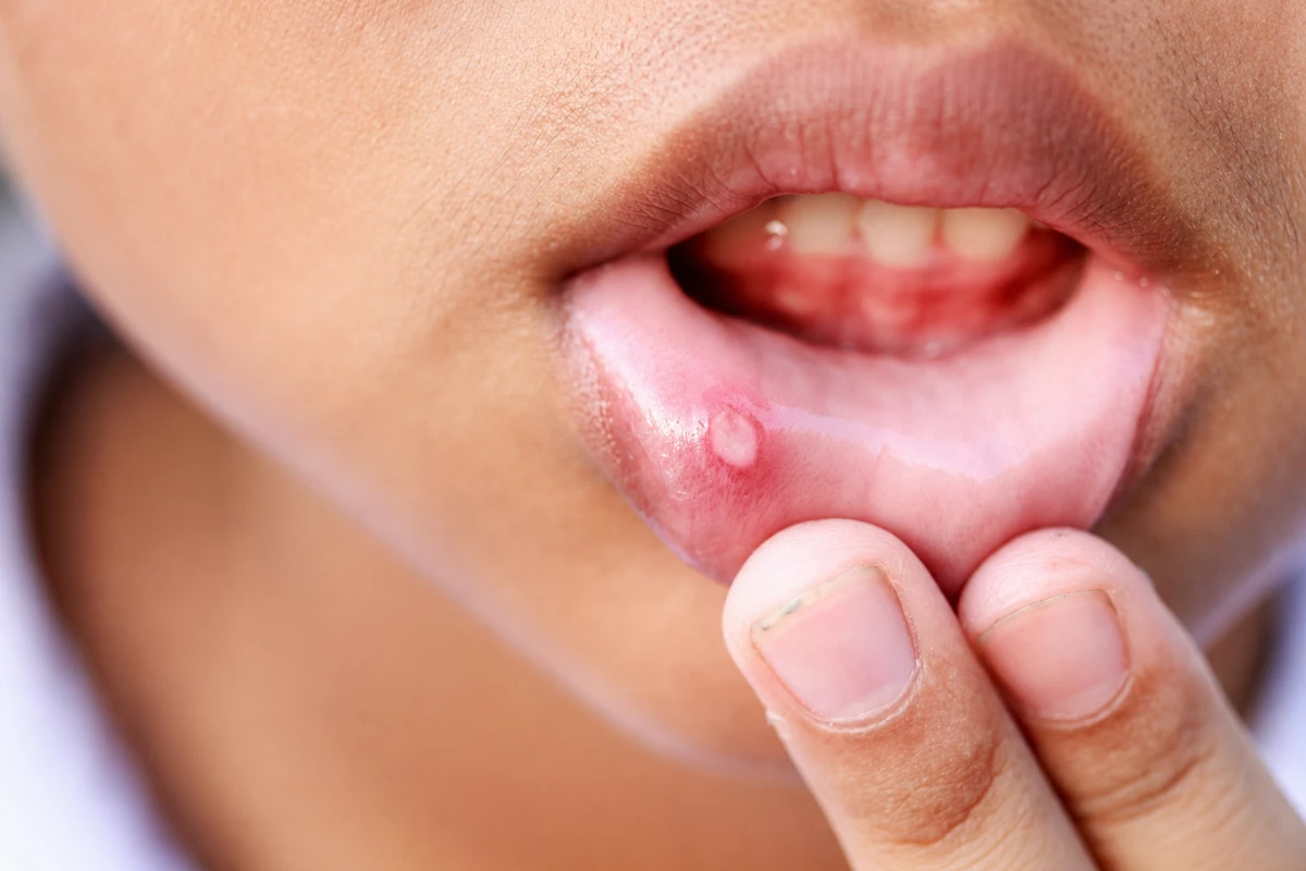 Close-up of a persistent mouth ulcer that should be examined by a dentist if it does not heal.