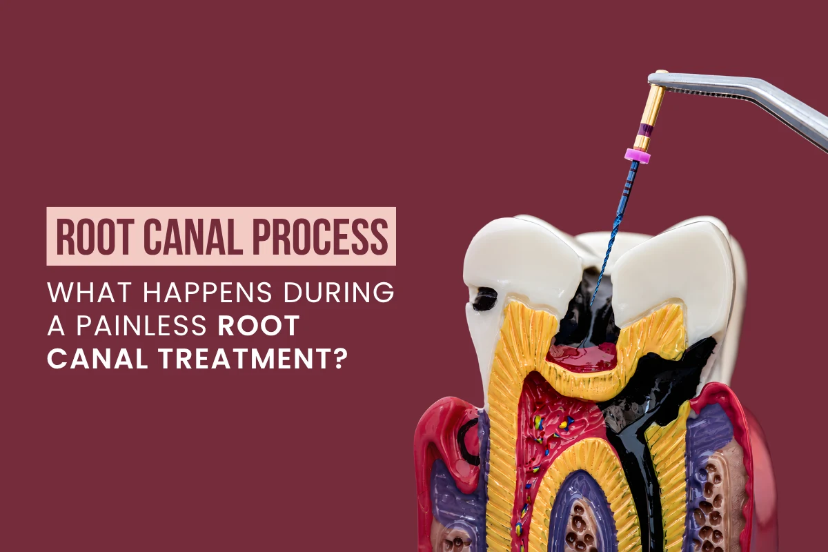 Cross-section model of a decayed tooth undergoing endodontic cleaning with an endodontic file during a root canal treatment.
