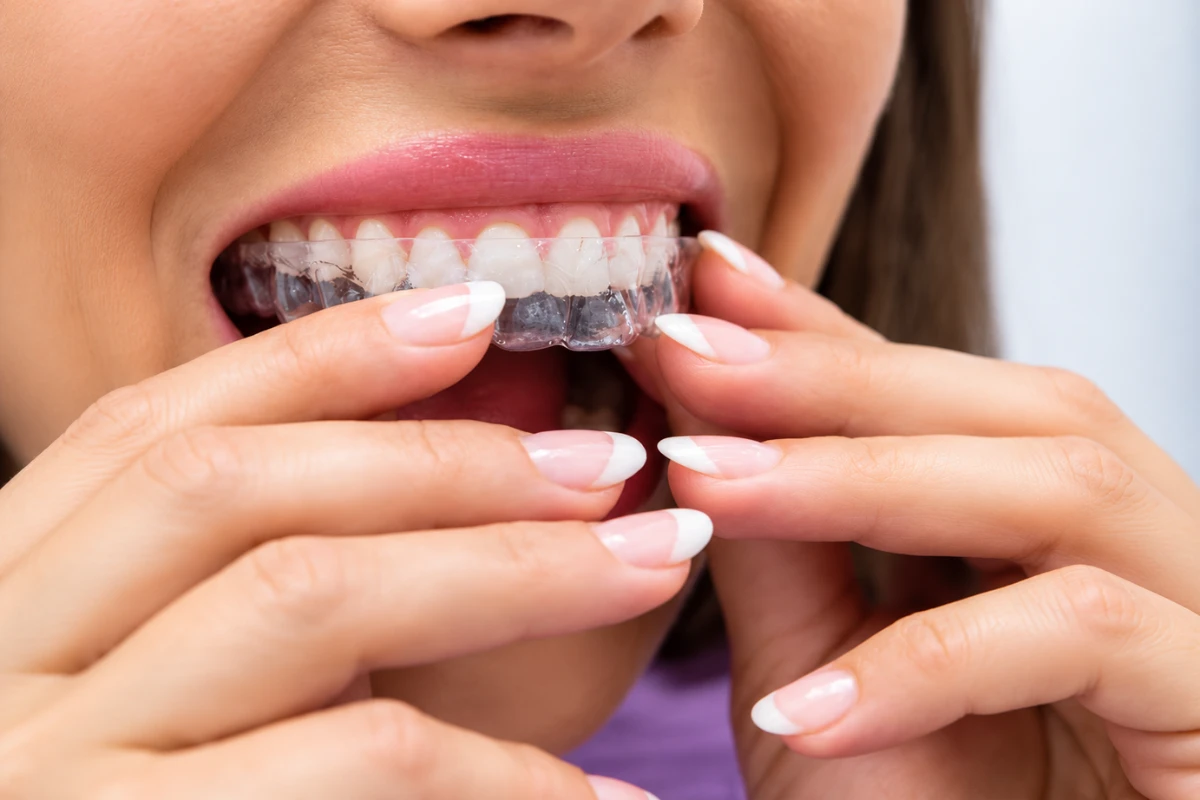 Patient carefully placing a transparent clear aligner tray onto their lower teeth