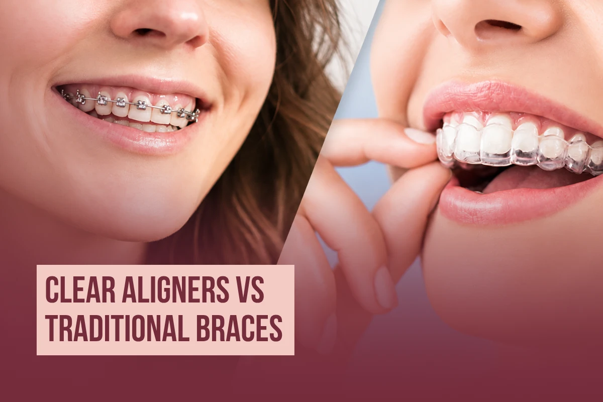 Side-by-side comparison showing traditional metal braces versus transparent clear aligners