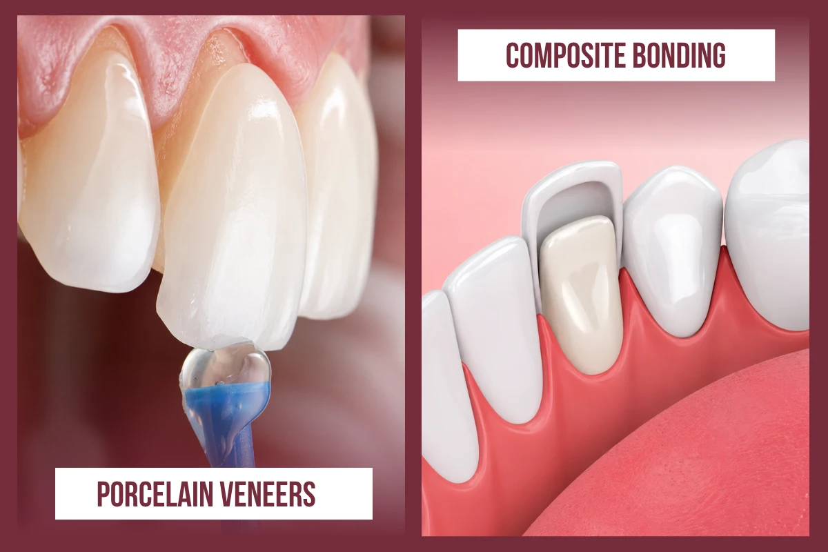 Comparison diagram highlighting the differences between porcelain veneers and composite bonding